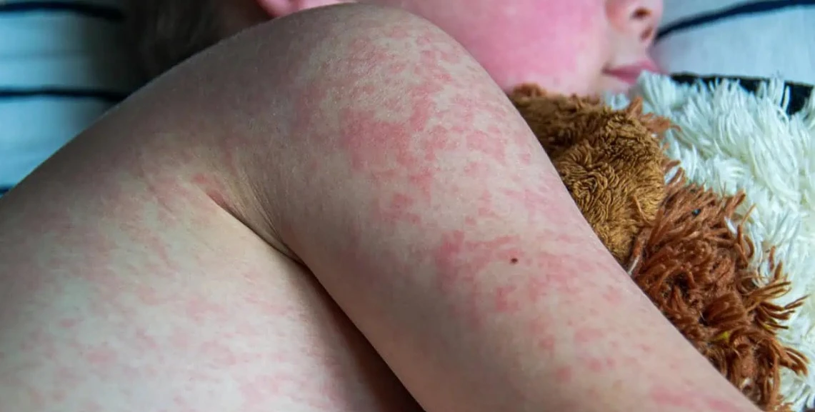 fourth measles case confirmed in durham region as exposure sites expand